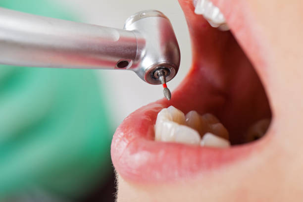 Best Knocked-Out Tooth (Avulsed Tooth) Treatment in Elm Springs, AR